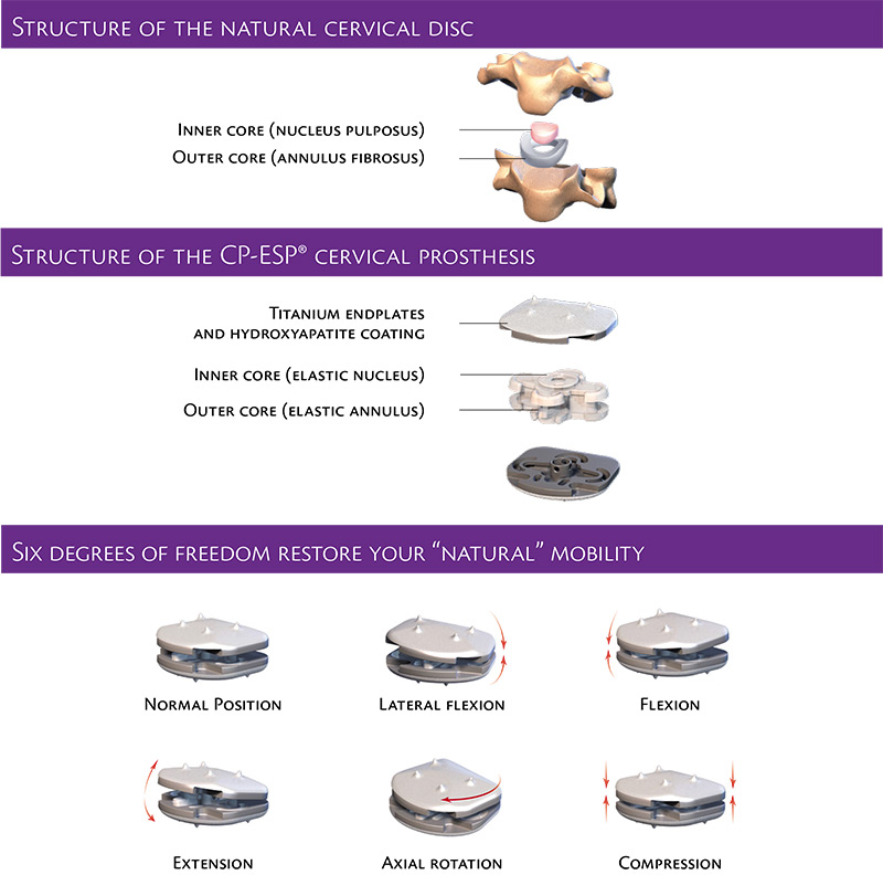 Artificial Disc Replacement