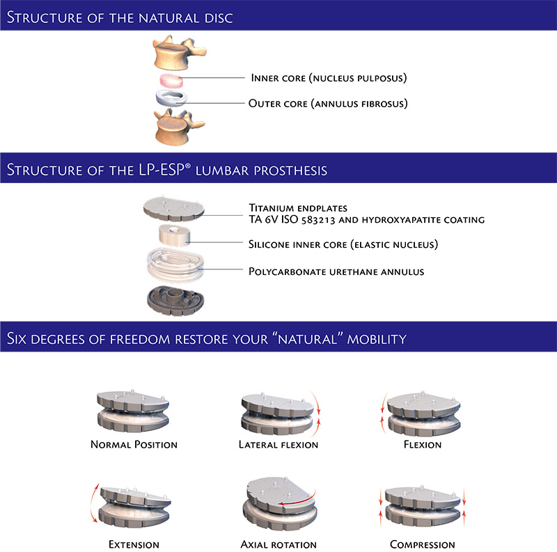 Artificial Disc Replacement